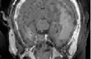 MRI and CT scan fused using BEMD Medical Fuison Image